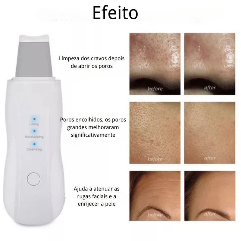 Aparelho de Peeling Esfoliante Ultrassônico Limpeza Facial Profunda